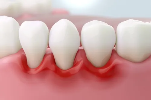close-up illustration of inflamed gums around teeth