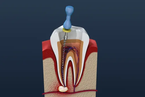 3D illustration of a root canal procedure cleaning the canals of an infected tooth