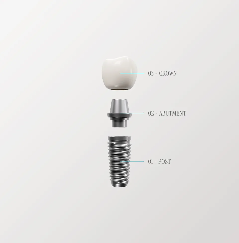 Dental implant component diagram