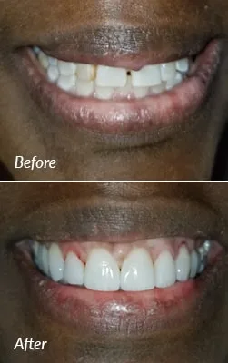 Before and after porcelain veneers smile transformation case 1.
