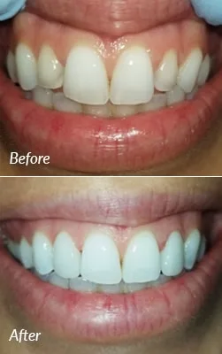 Before and after porcelain veneers smile transformation case 2.