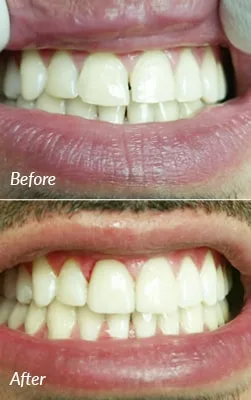 Before and after porcelain veneers smile transformation case 3.