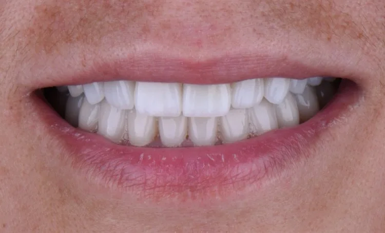 Smile gallery case 10 after