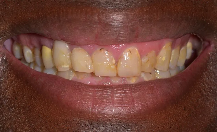 Smile gallery case 11 before