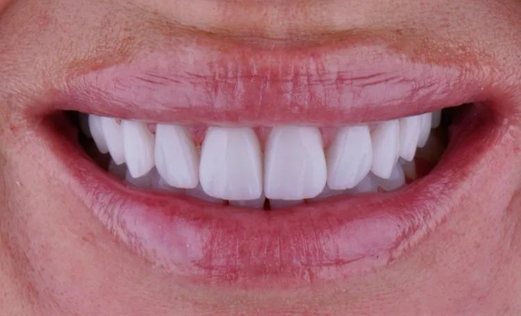 Smile gallery case 12 after