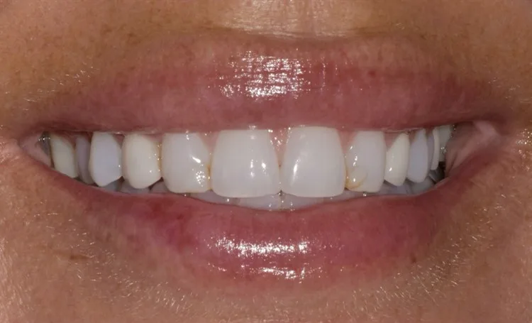 Smile gallery case 12 before