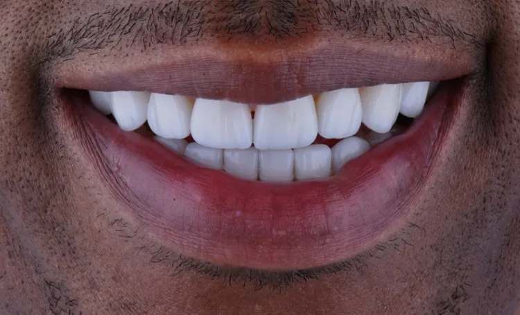 Smile gallery case 13 after