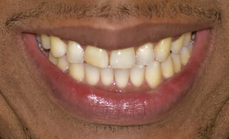 Smile gallery case 13 before