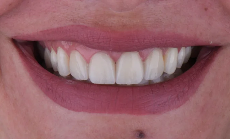 Smile gallery case 14 after