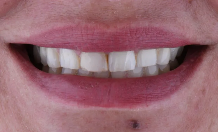 Smile gallery case 14 before