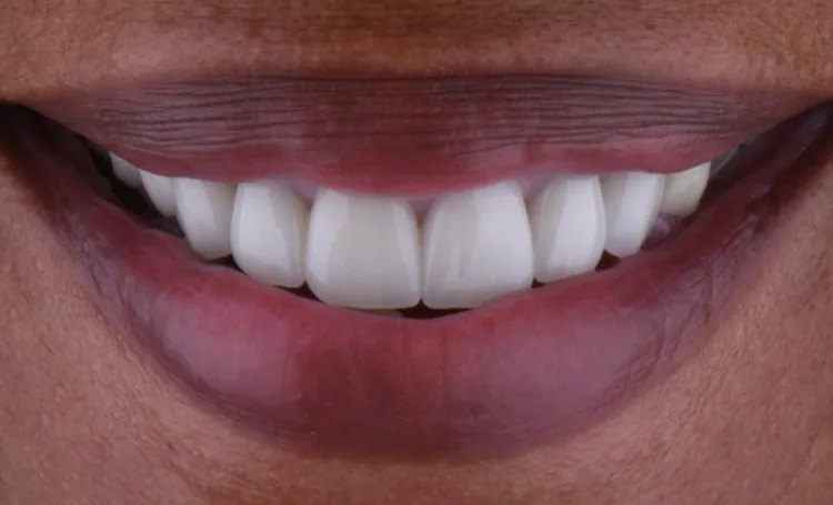 Smile gallery case 15 after