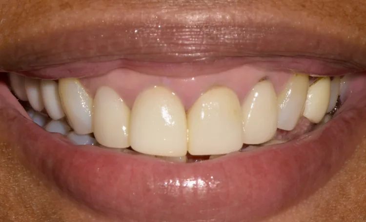 Smile gallery case 15 before