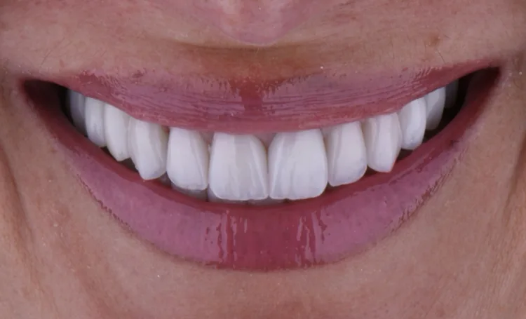 Smile gallery case 16 after