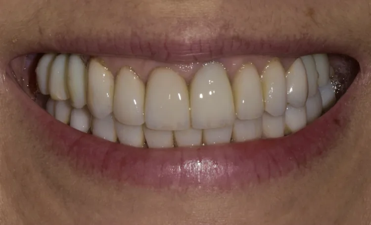 Smile gallery case 16 before