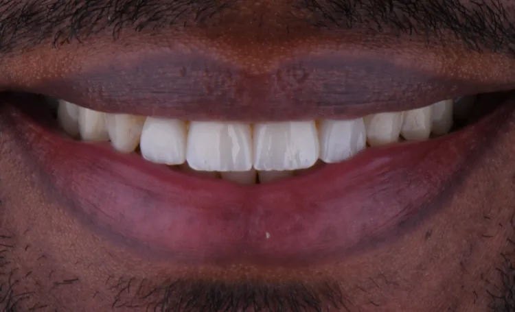 Smile gallery case 17 after