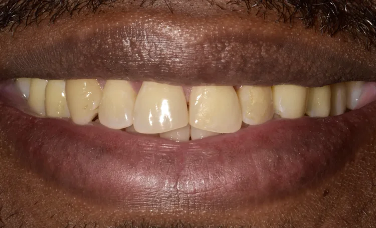 Smile gallery case 17 before