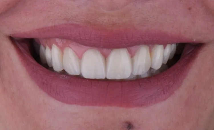 Smile gallery case 18 after