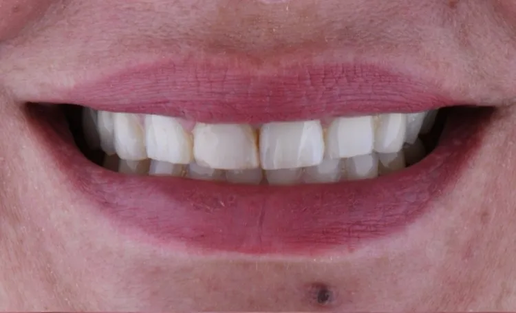 Smile gallery case 18 before