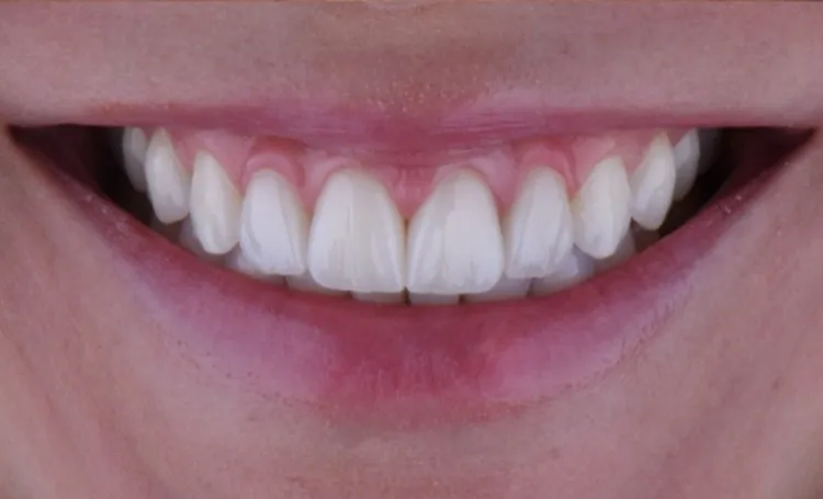 Smile gallery case 19 after