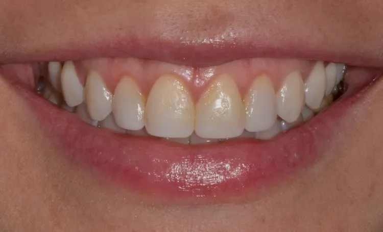 Smile gallery case 19 before