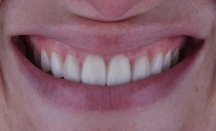 Smile gallery case 20 after