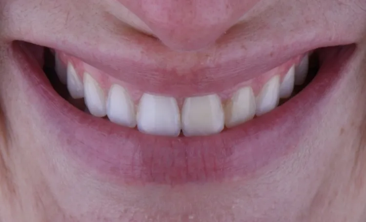 Smile gallery case 20 before