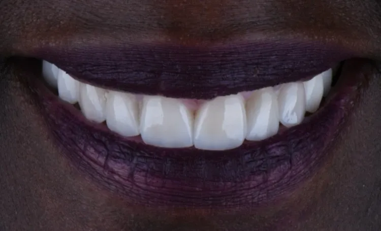 Smile gallery case 21 after