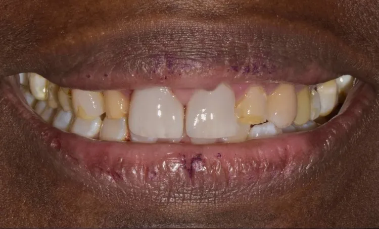 Smile gallery case 21 before