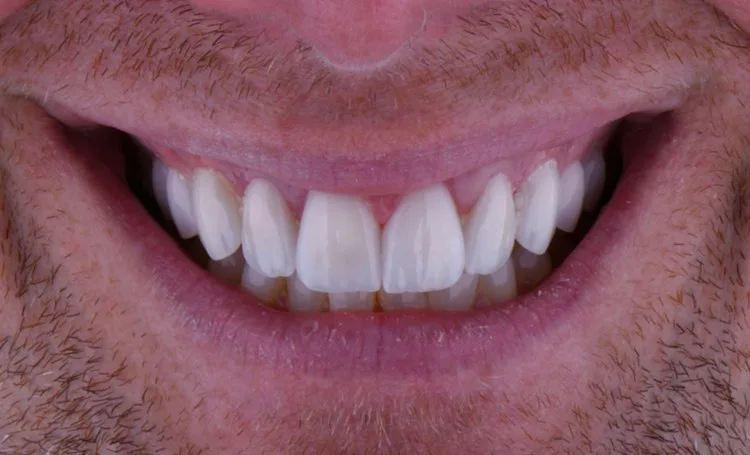 Smile gallery case 8 after