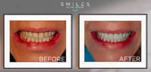 before and after teeth bonding
